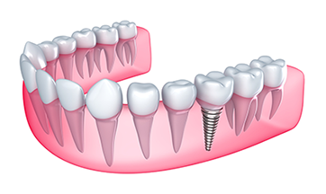 Dental Implants In Hilo, HI